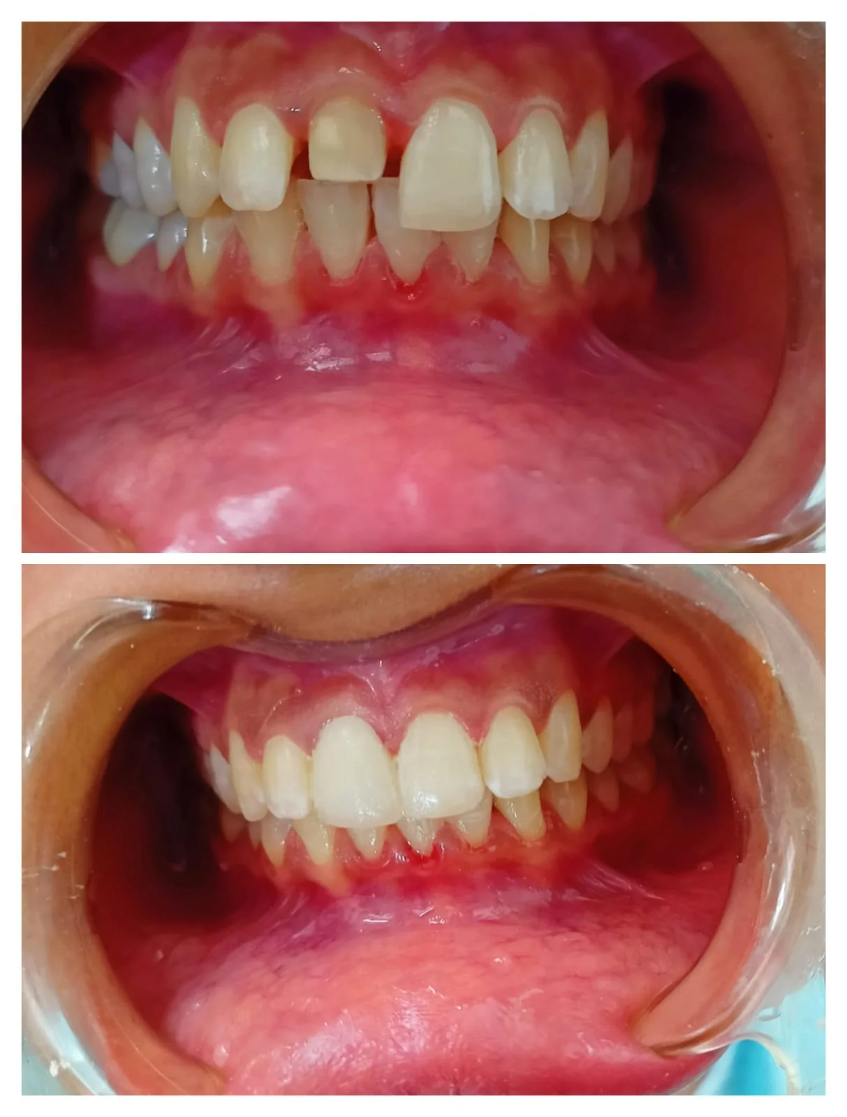 Anterior Smile Correction #8